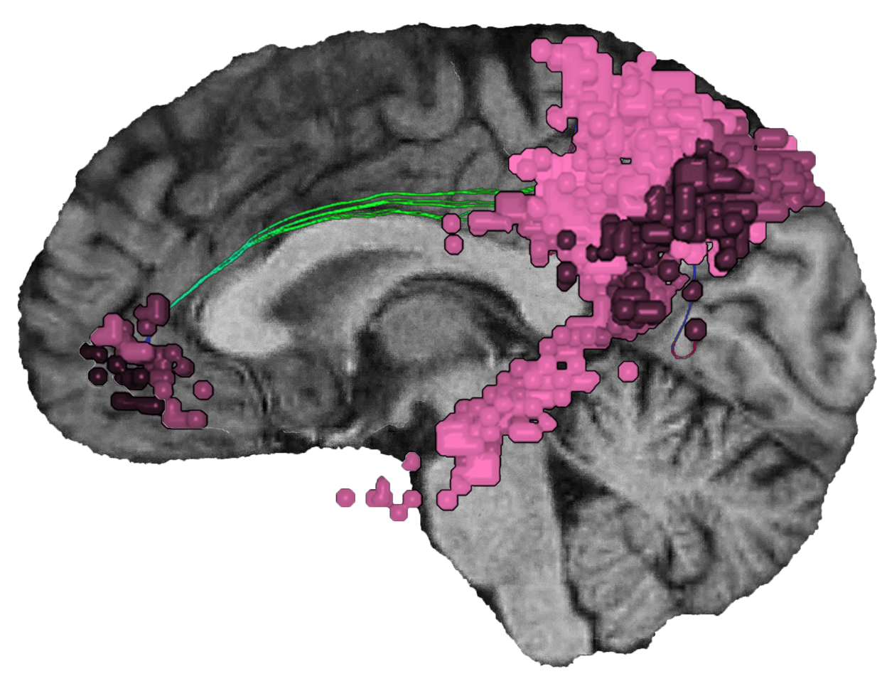 the-default-mode-network-dmn