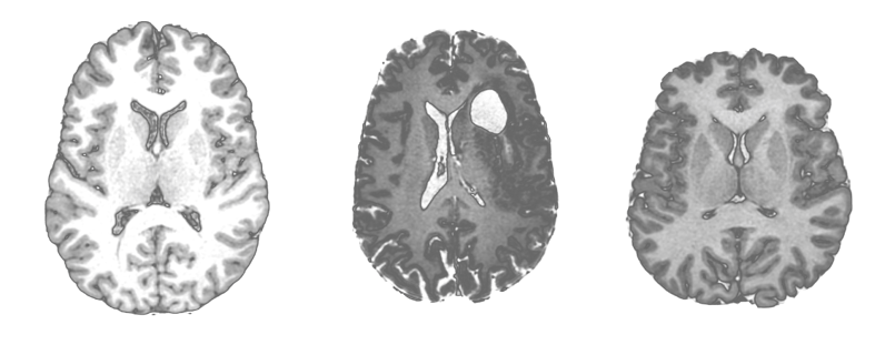 connectomics for neurosurgery and mental illness