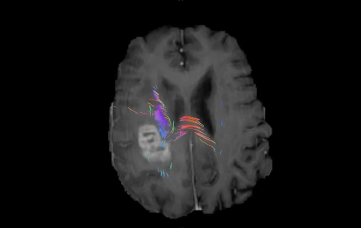 Networks as seen in Quicktome: Proximity of lesion to corticospinal tract.