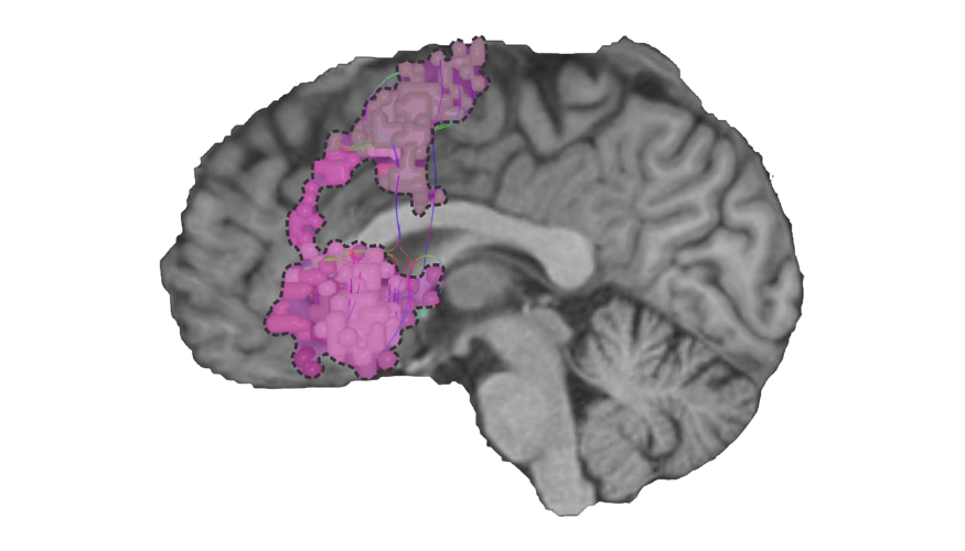 Salience Network-1