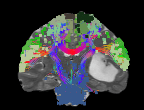 connectomics for neurological treatment and neurosurgery