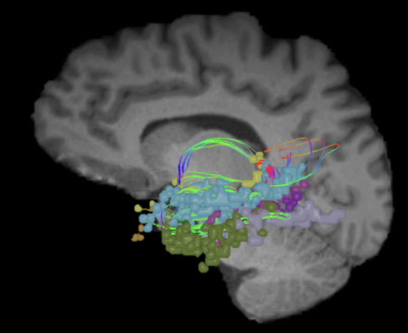 medialtemporal_sag